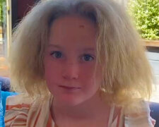 "Její vlasy nerostou od dvou let": jak vypadá desetiletá holčička, která má syndrom nečesaných vlasů